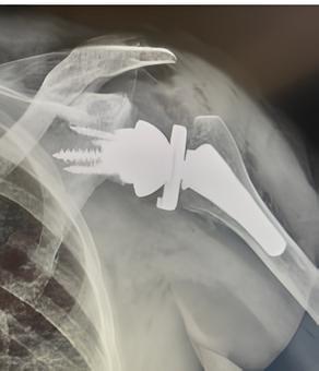 protesi inversa su rottura cuffia dei rotatori artroscopia roma clinica sanatrix