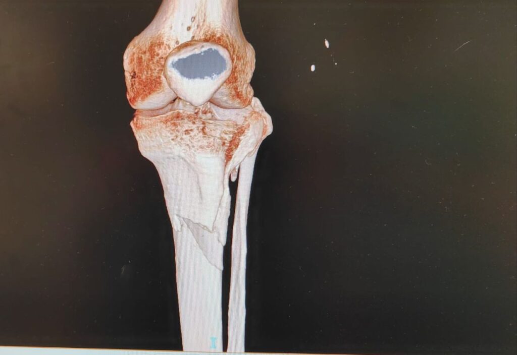 storie di successo clinica sanatrix roma frattura tibiale scomposta trattamento osteosintesi dopo