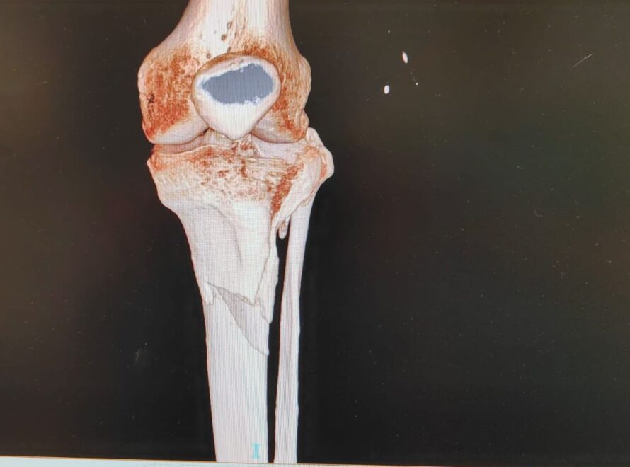storie di successo clinica sanatrix roma frattura tibiale scomposta trattamento osteosintesi dopo