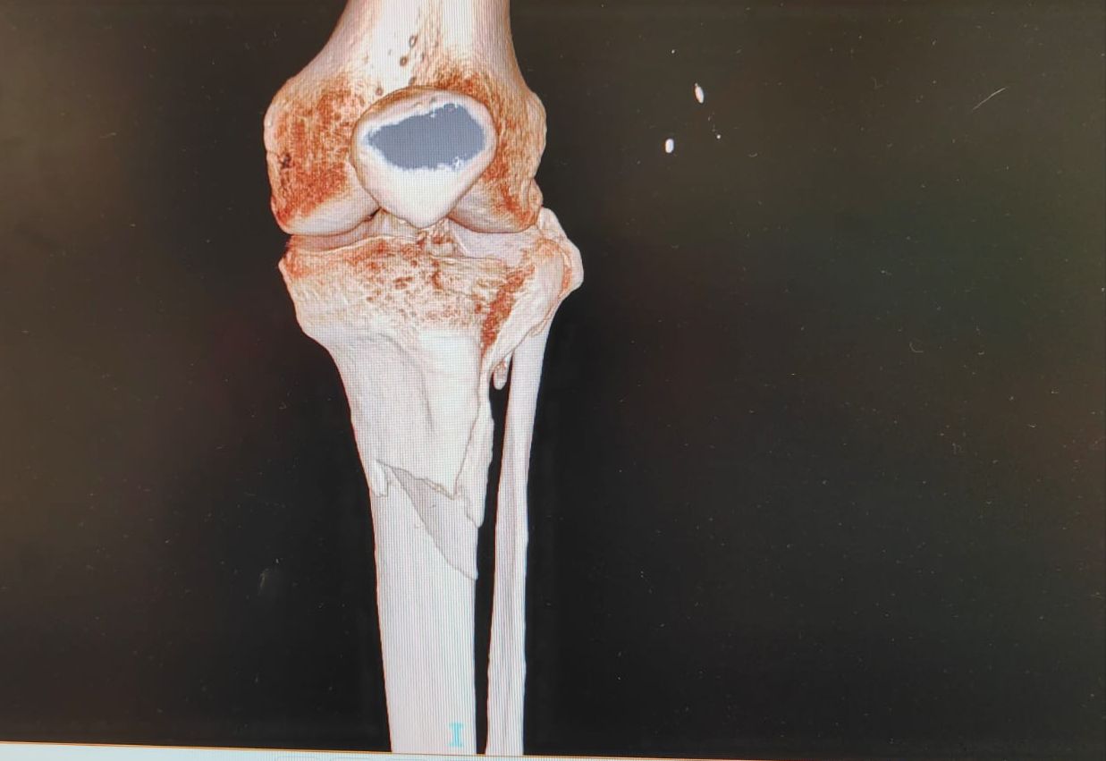storie di successo clinica sanatrix roma frattura tibiale scomposta trattamento osteosintesi dopo